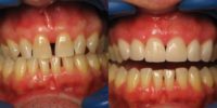 35-44 year old man treated with Porcelain Veneers