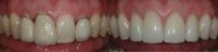 35-44 year old woman treated with Porcelain Veneers