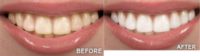 35-44 year old woman treated with Zoom Whitening