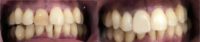 35-44 year old man treated with Porcelain Veneers