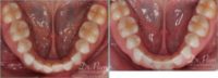 35-44 year old woman treated with Lingual Braces