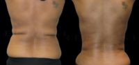38 year old woman treated with Vaser Liposuction