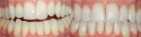 35-44 year old man treated with Invisalign
