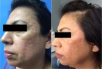 35-44 year old woman treated with TCA Peel