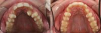 35-44 year old woman treated with Clear Braces