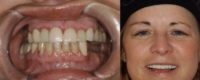 35-44 year old woman treated with Dental Crown