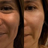 35-44 year old woman treated with Botox