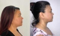 35-44 year old woman treated with Buccal Fat Removal, Chin Liposuction