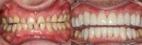 35-44 year old man treated with Smile Makeover