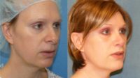 35-44 year old woman treated with Facial Feminization Surgery