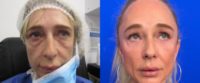 35-44 year old woman treated with Eyelid Surgery