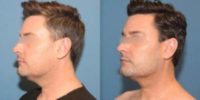 35-44 year old man treated with Chin Liposuction