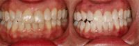 35-44 year old man treated with Zoom Whitening