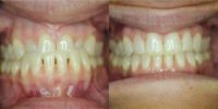 35-44 year old woman treated with Invisalign