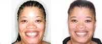 35-44 year old woman treated with Braces and veneers
