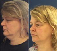 44 year old lady treated with Cool Sculpting to the neck area.
