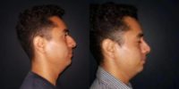 35-44 year old man treated with Rhinoplasty