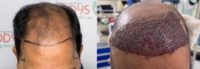 45-54 year old man treated with Hair Transplant