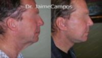 45-54 year old man treated with Facelift