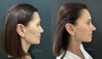 45-54 year old woman treated with Rhinoplasty, Facelift