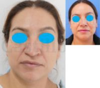 45-54 year old woman treated with Rhinoplasty