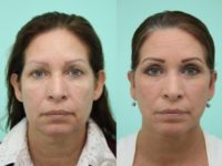 45-54 year old woman treated with Facelift, Neck Lift, Upper Eyelid Surgery and Ear Surgery