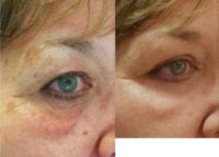 45-54 year old woman treated with Eyelid Surgery