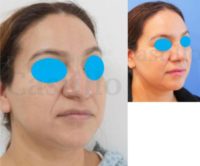 45-54 year old woman treated with Rhinoplasty