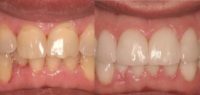 45-54 year old man treated with Dental Implants