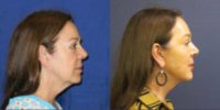 45-54 year old woman treated with SMAS Facelift