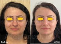 45-54 year old woman treated with Rhinoplasty