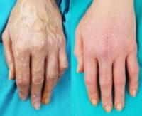 45-54 year old woman treated with Hand Rejuvenation