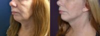 45-54 year old woman treated with Facelift