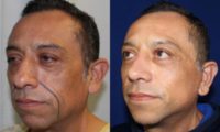 45-54 year old man treated with Facelift