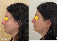 45-54 year old woman treated with Rhinoplasty