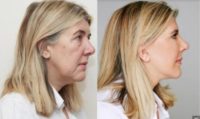 45-54 year old woman treated with Facelift