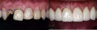 45-54 year old man treated with Dental Crown