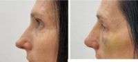 45-54 year old woman treated with Revision Rhinoplasty