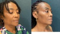 45-54 year old woman treated with African American Rhinoplasty