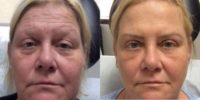 45-54 year old woman treated with Botox, Vollure, and Volbella