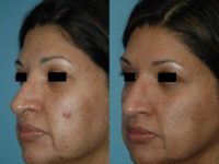 45-54 year old woman treated with Microneedling