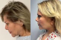 45-54 year old woman treated with Deep Plane Facelift, Facelift, SMAS Facelift, Lower Facelift