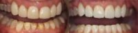 45-54 year old woman treated with Porcelain Veneers