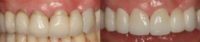 55-64 year old woman treated with Dental Crowns and Bridge