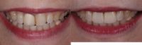 55-64 year old woman treated with Porcelain Veneers