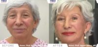 55-64 year old woman treated with Deep Plane Facelift, Double Eyelid Surgery, Lip Lift, Facial Fat Transfer