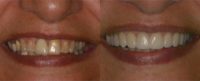 55-64 year old woman treated with Smile Makeover