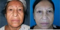 55-64 year old woman treated with Facelift