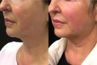 57 year old woman treated with Ultherapy