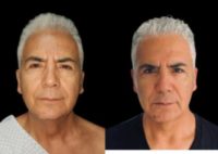 55-64 year old man treated with Facial Fat Transfer
